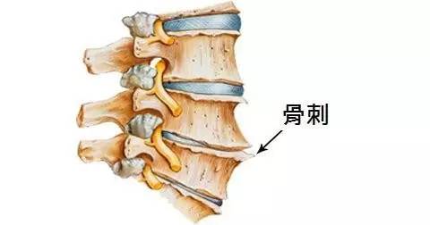 长“骨刺”了怎么办？