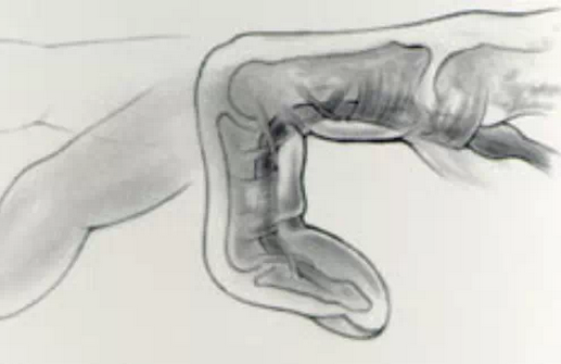 狭窄性腱鞘炎的诊断及治疗