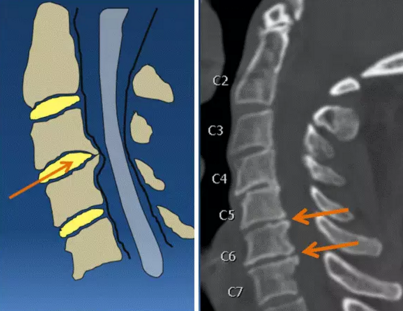 脊柱退变的影像诊断技巧