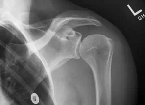 常见骨折与脱位的X线表现