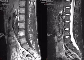 脊椎肿瘤的影像诊断思路解析
