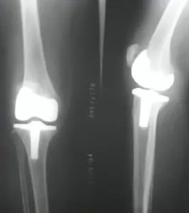 膝关节置换的常见问题分析