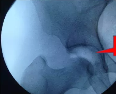 揭秘髋关节镜的手术过程