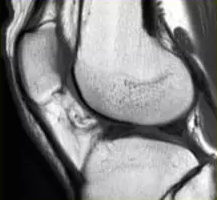 膝关节半月板 MRI 入门，看这篇就够了！