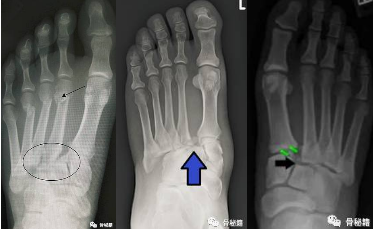 跖跗关节（Lisfranc）损伤的治疗策略与技巧