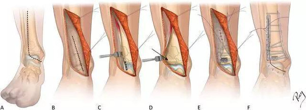 Pilon骨折手术的基本原则及技巧