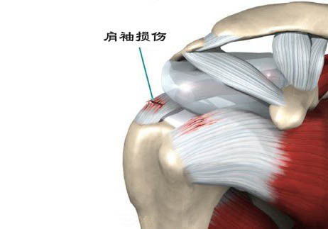 收藏 | 肩袖损伤的诊断与治疗策略