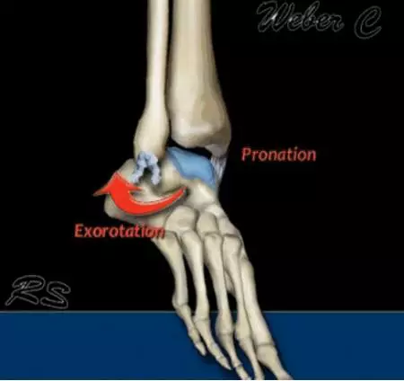特殊类型的踝关节骨折（一）：Maisonneuve Fracture