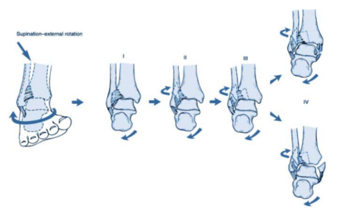 特殊类型的踝关节骨折（二）：Bosworth Fracture