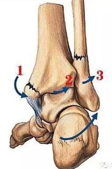 特殊类型的踝关节骨折（四）：Dupuytren Fracture