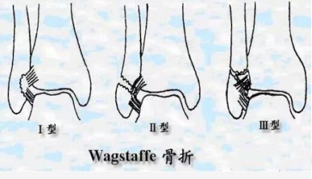 特殊类型的踝关节骨折（五）：Wagstaffe Fracture