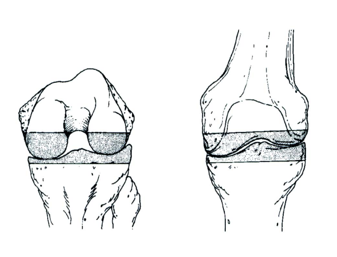 收藏 | 全膝关节置换的截骨原则