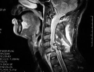下颈椎骨折脱位的外科手术治疗