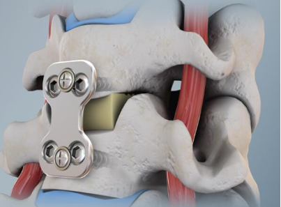  颈椎人工椎间盘在颈椎手术中的应用
