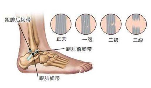 踝关节的韧带解剖及其损伤表现