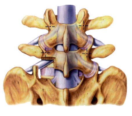 腰椎融合术的常用术式及其应用