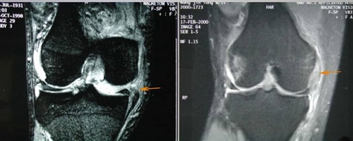 膝关节损伤MR诊断的内容及技巧