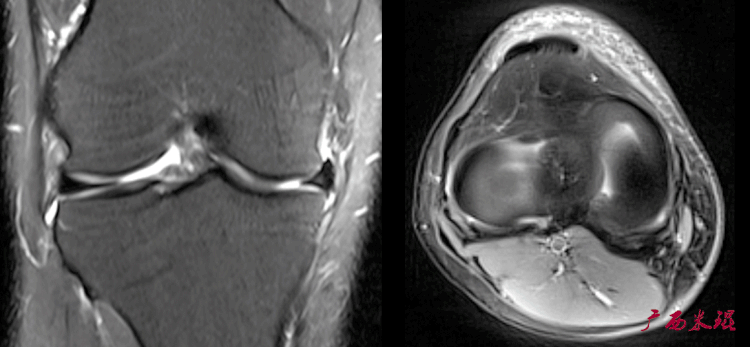 推荐 | 半月板损伤的MRI诊断基础 