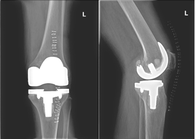 膝关节置换术后感染的防治方法