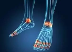 足跟痛五种常见疾病的诊断与治疗