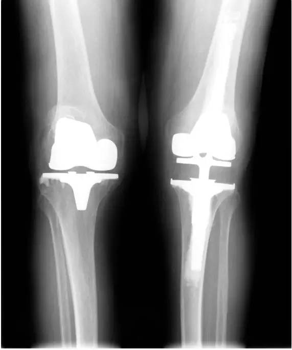 全膝关节置换术后膝关节不稳的诊治