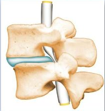 腰椎管狭窄症的病理解剖及治疗策略 