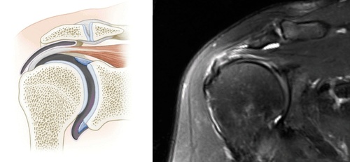 一文教你读懂肩袖损伤分型与MRI阅片