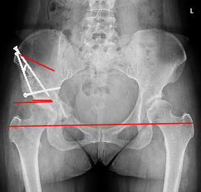 如何完成标准的髋臼周围截骨术? 