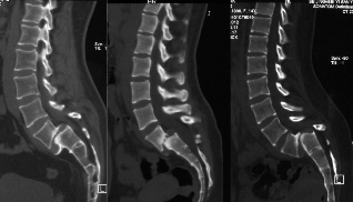 腰椎滑脱的临床分型与影像学评估 
