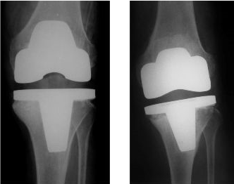 膝关节置换术如何正确选择假体？ 