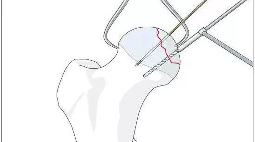 AAOS 2018：全皮质骨螺钉与迷你钢板的复位技巧
