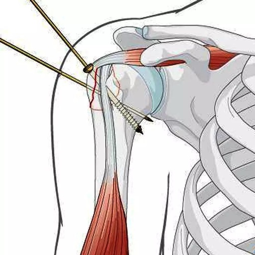 肱骨近端骨折内固定手术的经验与教训 
