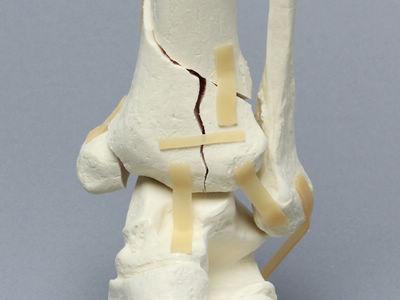 系统讲解：踝关节骨折的Lauge-Hansen分型 