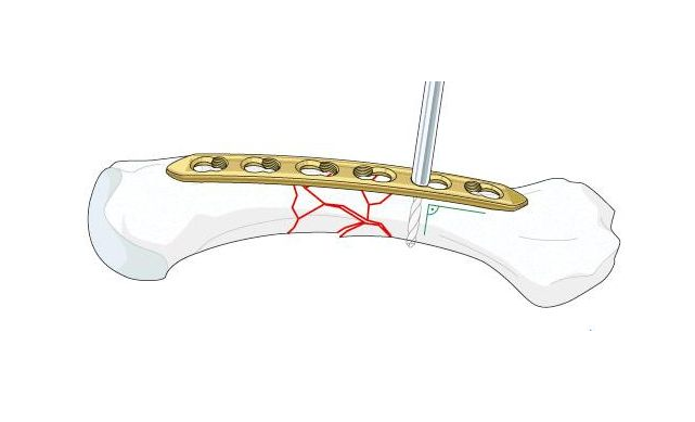 “金手指”在股骨干骨折闭合复位中的应用 