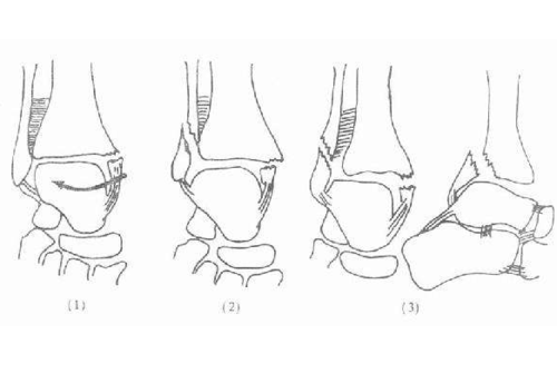 踝关节后外侧及外侧入路的手术技巧及指征 
