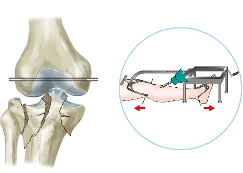 双反牵引闭合复位微创治疗胫骨平台骨折 
