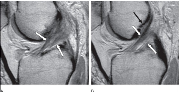 前交叉韧带常见损伤及病变的MRI 表现 