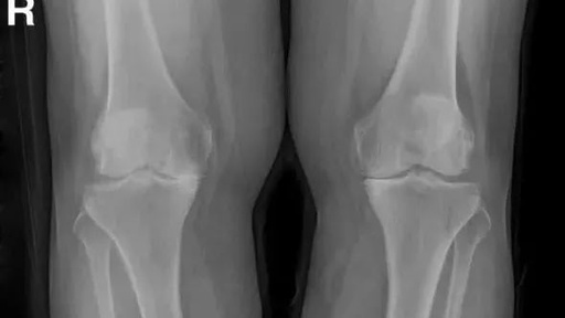 膝关节骨关节炎手术保膝的取舍 