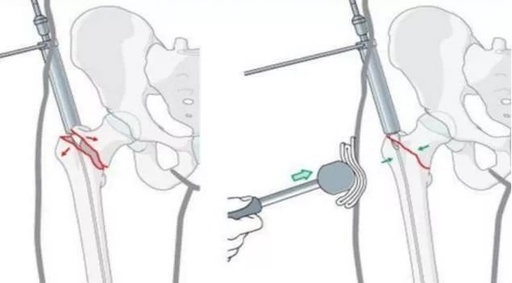髓内固定辅助技术治疗股骨粗隆间及粗隆下骨折