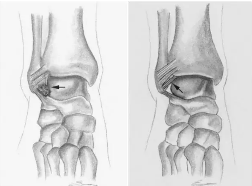 一篇掌握：踝关节撞击综合征的影像学诊断