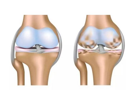如何做好膝关节软骨修复？ 