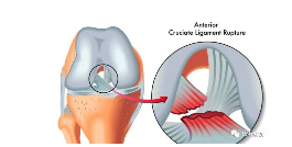 膝关节前交叉韧带损伤诊断与治疗