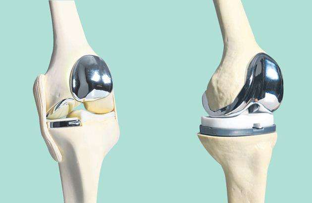 系统详解：复杂性膝关节置换术处理策略 