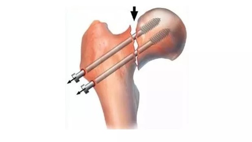 如何治疗股骨颈剪切型骨折？看这篇就够了！