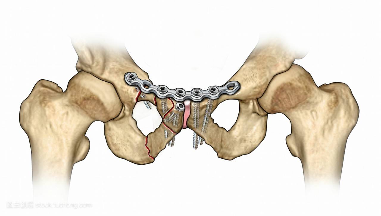 精选 | 骨盆骨折的前环治疗策略与技巧