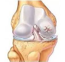 什么样的膝骨性关节炎适合关节镜手术？ 