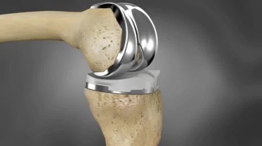 初次膝关节置换术的手术要点及技巧 