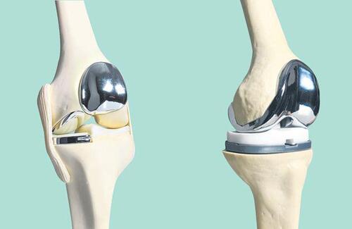 人工全膝关节置换与下肢力线重建 