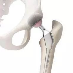 髋关节翻修术中严重髋臼骨缺损的处理办法