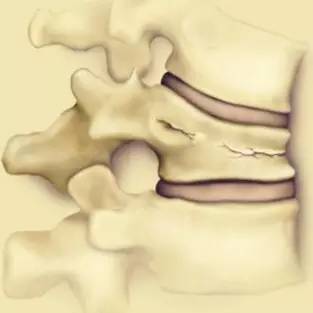 透彻解析：骨质疏松椎体压缩性骨折的治疗策略 